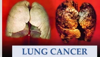 Lung Cancer Without Smoking