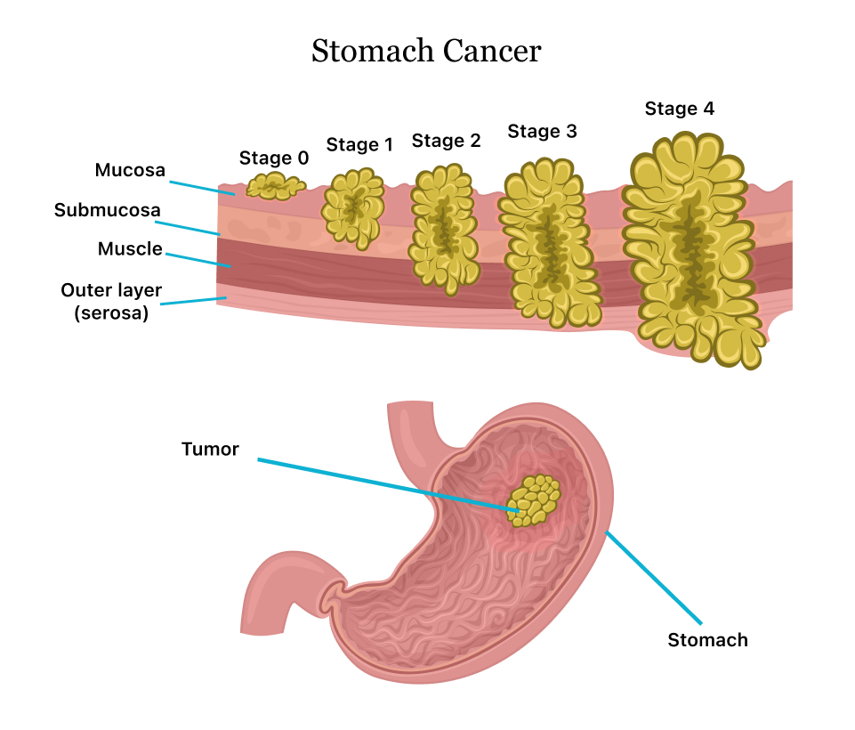 Stomach Cancer Symptoms