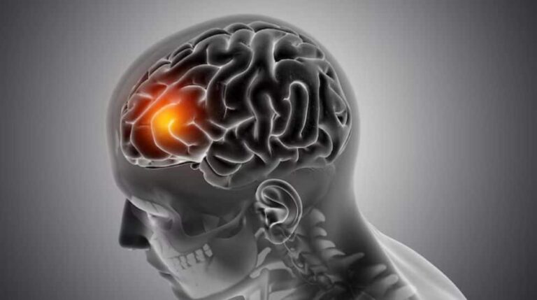 World Brain Tumour Day 2025: Early Diagnosis And Awareness Key To Brain Health For All Ages | Health News