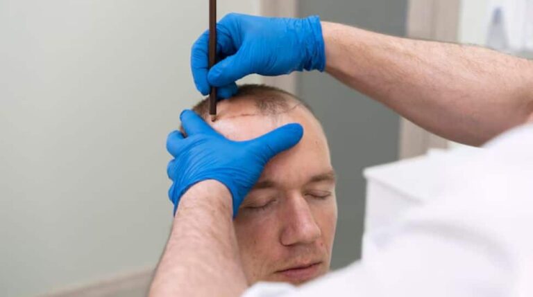 People Die During Hair Transplant Surgery? Doctor Shares Inputs On This | Health News